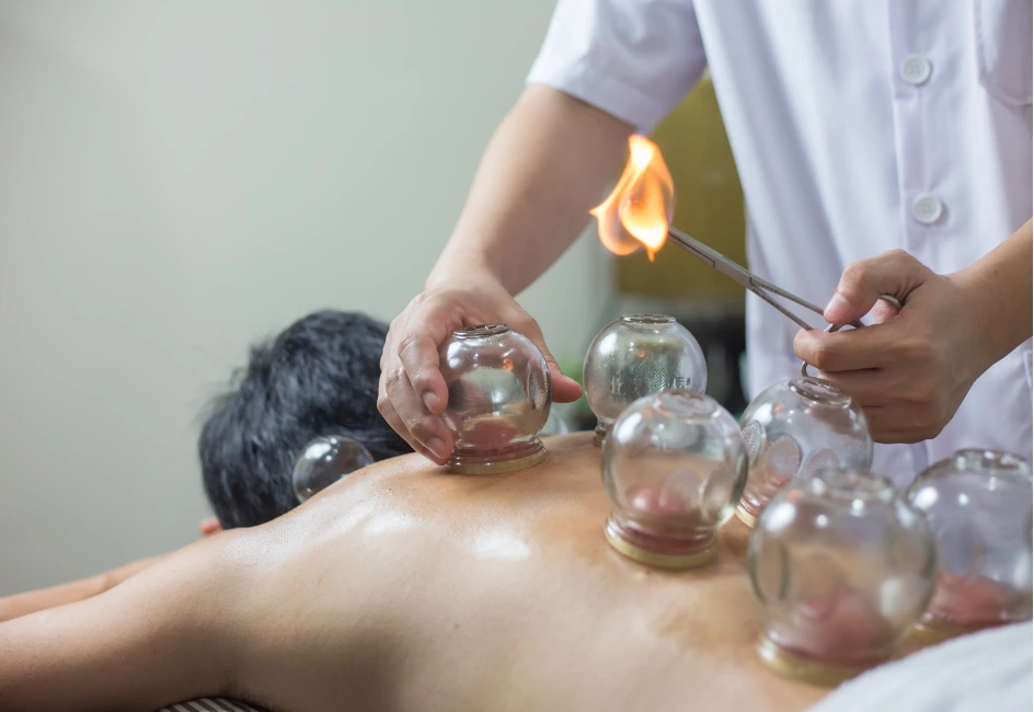 Cupping Therapy Sessions Anesti Acupuncture Cupping Therapy Sessions Anesti Acupuncture